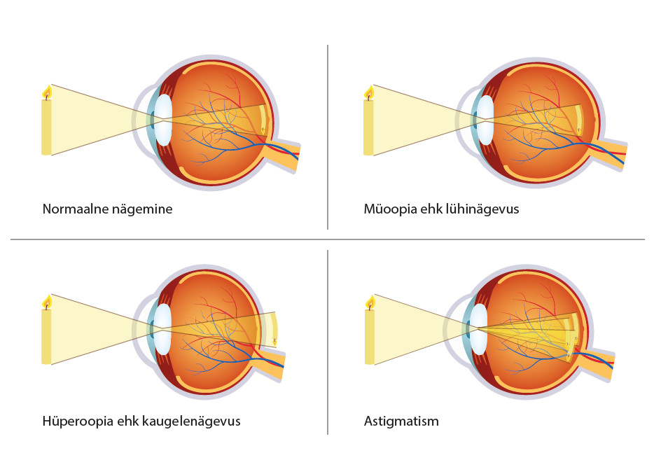 lühinägelikkus ja kaugnägelikkus